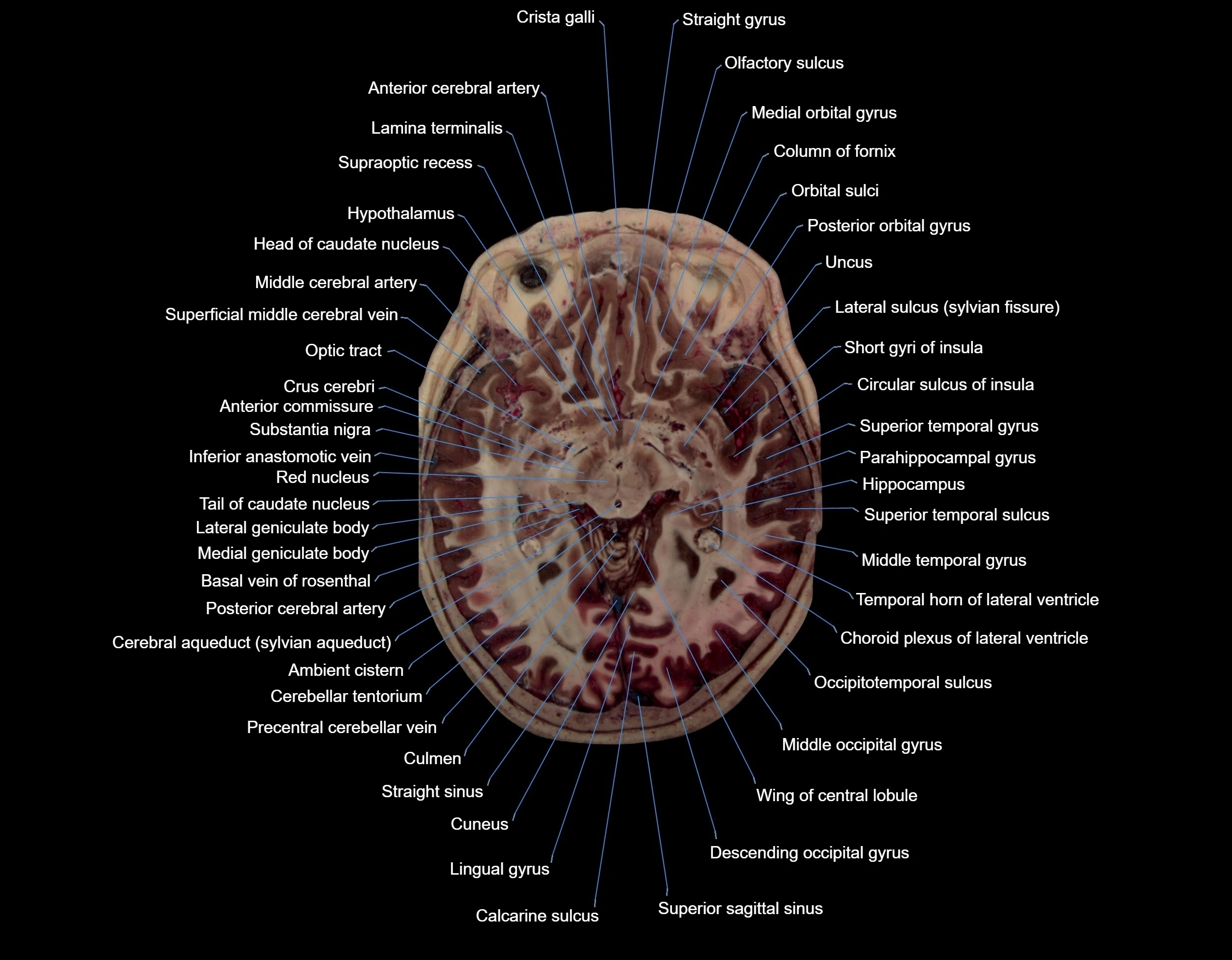 MRI Brain axial cross sectional radiology anatomy 3T image  -img-000037.webp